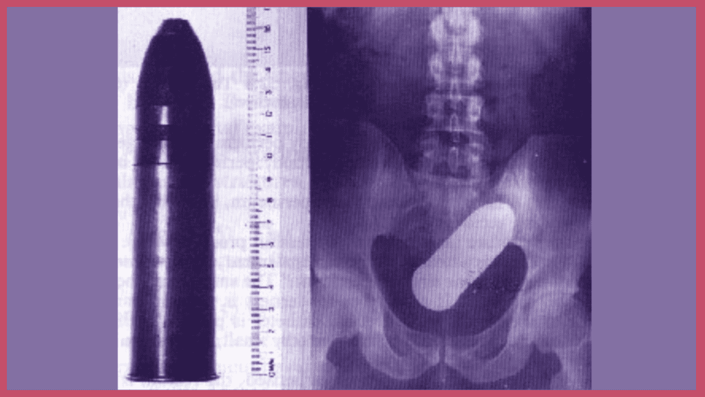 Var : il se présente aux urgences avec un obus dans l’anus